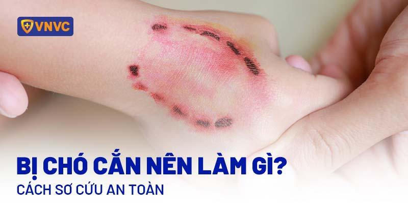 Chó Lạ Cắn Vào Tay Phải
