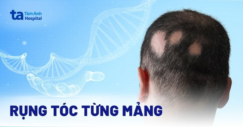 Rụng tóc từng mảng trong mơ